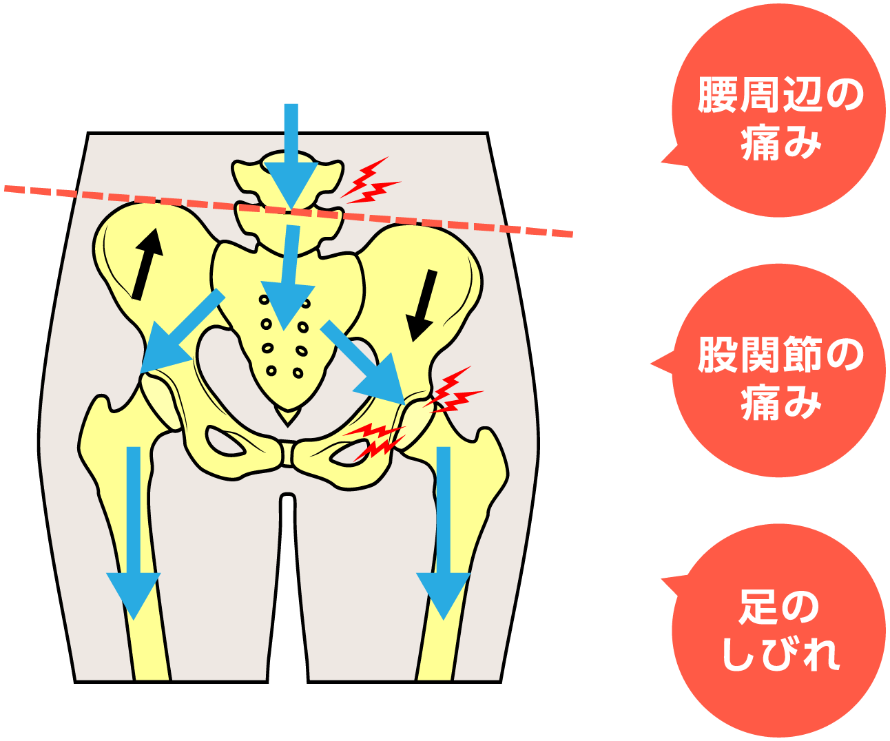 仙腸関節に歪みがある場合